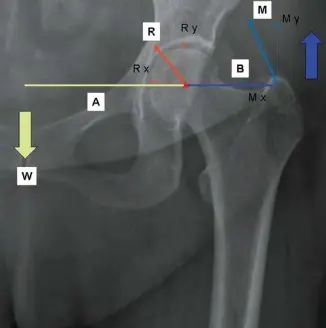 صورة توضيحية لـ إتقان توازن الأنسجة الرخوة لمفصل ورك صناعي مثالي: دليل شامل للمرضى مع الأستاذ الدكتور محمد هطيف