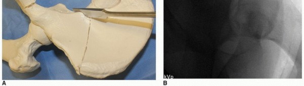 Illustration 20 for Periacetabular Osteotomy: Realigning your hip via the superior pubic ramus