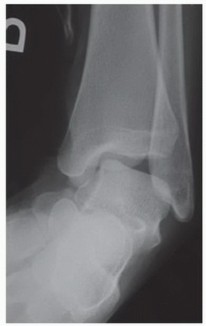 Illustration of repair of peroneal tendon - Dr. Mohammed Hutaif