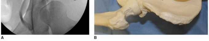 Illustration 17 for Periacetabular Osteotomy: Realigning your hip via the superior pubic ramus