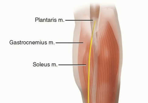 Illustration of percutaneous versus open - Dr. Mohammed Hutaif