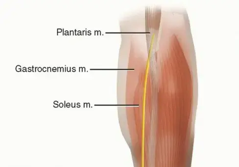 صورة توضيحية لـ تمزق وتر أخيل: دليل شامل للعلاج والتعافي مع الأستاذ الدكتور محمد هطيف في اليمن