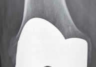 Illustration 19 for Monoblock Total Knee: When to Use & What to Avoid