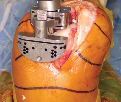 Illustration 20 for Minimize Pain, Maximize Recovery: TKA with Parapatellar