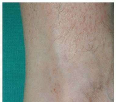 Illustration of insertional achilles tendinopathy - Dr. Mohammed Hutaif