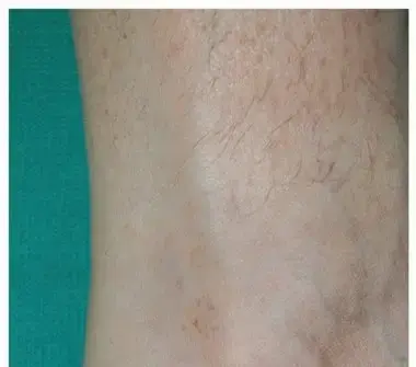 التهاب وتر أخيل الإدخالي: دليلك الشامل لراحة قدميك مع الأستاذ الدكتور محمد هطيف