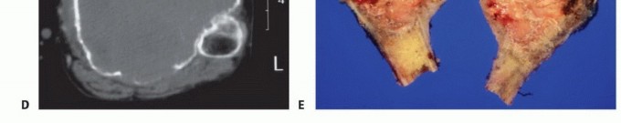 صورة طبية: معالجة الأورام المعقدة في قصبة الساق القريبة حلول الحفاظ على الأطراف