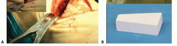 Illustration 20 for High Tibial Osteotomy: Realignment for Lasting Knee Pain Relief