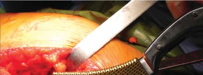 صورة طبية: تقنية الجذع القصير لاستبدال مفصل الورك الكلي: نهج الأستاذ الدكتور محمد هطيف لتدخل جراحي أقل ونتائج أفضل