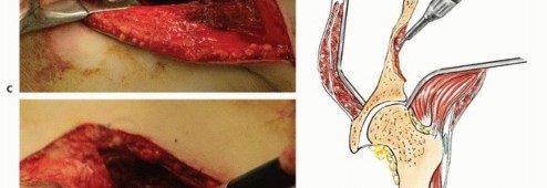 توضيح طبي: جراحة نقائل الحوض: حل شامل لآلام العظام واستعادة الحركة مع الأستاذ الدكتور محمد هطيف