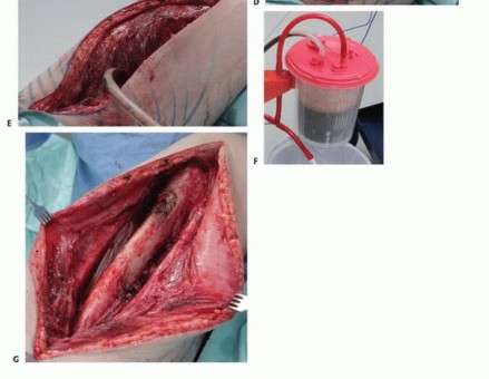 صورة طبية: استئصال ساركوما العضلة الرباعية مع الحفاظ على الطرف: دليل شامل للمرضى مع الأستاذ الدكتور محمد هطيف في صنعاء