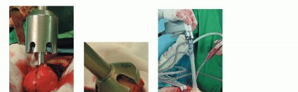 صورة طبية: ترميم مفصل الورك: الحل الأمثل للحفاظ على عظم رأس الفخذ في صنعاء مع الدكتور محمد هطيف