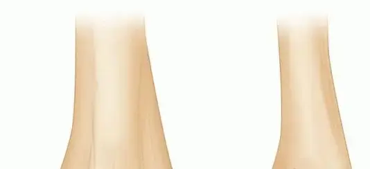 كسور اللقمة والبكرة في مفصل المرفق: دليل شامل للعلاج والتعافي مع الأستاذ الدكتور محمد هطيف