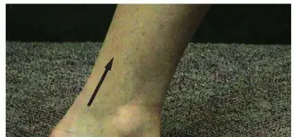 سوء التئام عظم الكعب: دليل شامل للمرضى في اليمن والخليج العربي مع الأستاذ الدكتور محمد هطيف