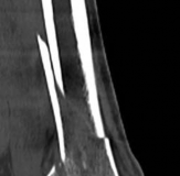 Illustration 9 for Decoding Pilon Fractures: Anterolateral and Medial Fragments Revealed