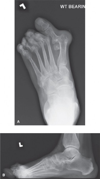 Painful Foot Deformities? Explore Arthrodesis Lesser Toe Solutions