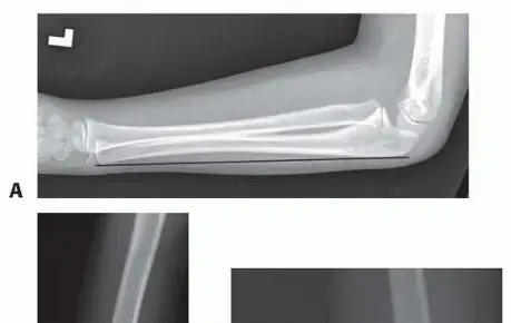 صورة توضيحية لـ التعافي من إصابة مونتيجيا المنسية: دليل شامل للمرضى مع الأستاذ الدكتور محمد هطيف