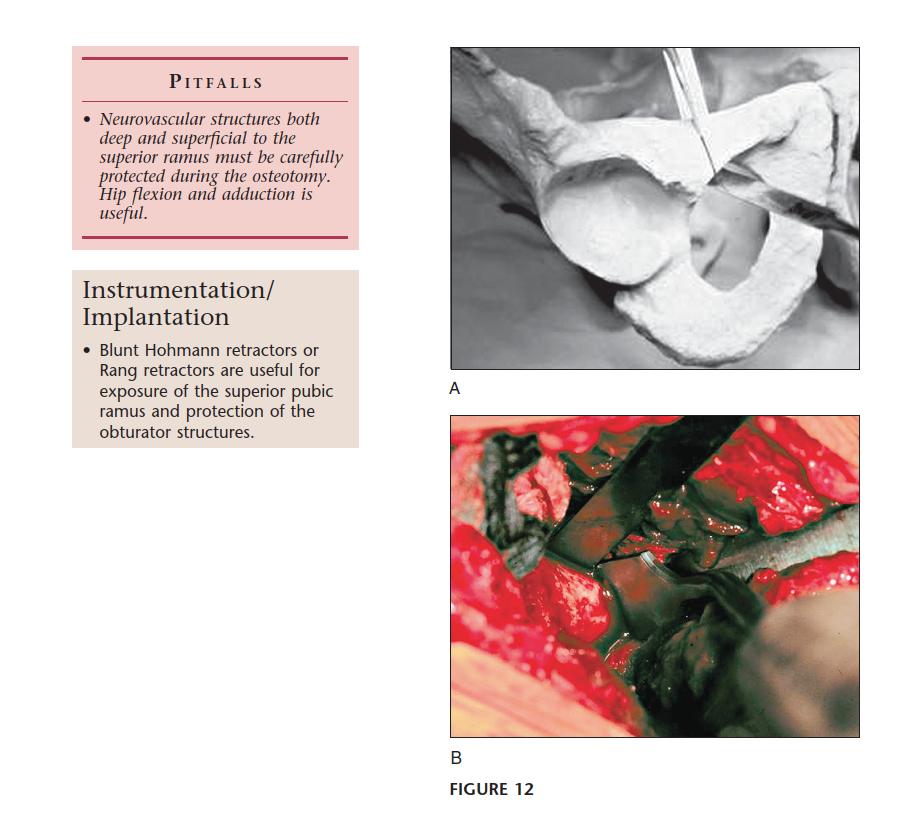 Illustration 27 for Bernese PAO: Unlocking the Procedure with Level V Evidence Insights