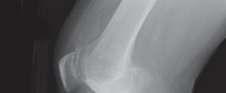 Illustration 4 for Cemented TKA Figure: Your Visual Guide to Surgical Success