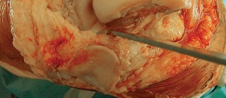 Illustration 23 for Revision of Failed UKA: Your Guide to Successful Treatment