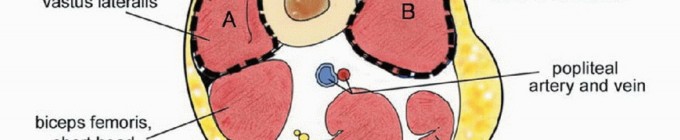 صورة توضيحية لـ استئصال ساركوما العضلة الرباعية مع الحفاظ على الطرف: دليل شامل للمرضى مع الأستاذ الدكتور محمد هطيف في صنعاء