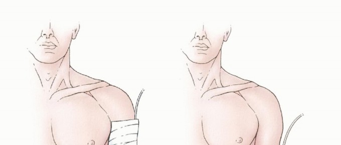 صورة طبية: بتر الذراع فوق وتحت الكوع: متى ولماذا يصبح ضرورة طبية؟ دليل شامل من الأستاذ الدكتور محمد هطيف