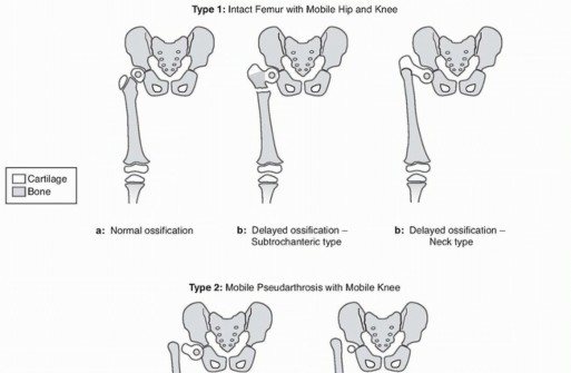 Treatment for Congenital Femoral Deficiency: What You Need to Know