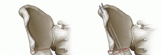 Triple Innominate Osteotomy: Advanced Hip Dysplasia Correction