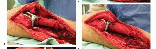 صورة طبية: معالجة الأورام المعقدة في قصبة الساق القريبة حلول الحفاظ على الأطراف