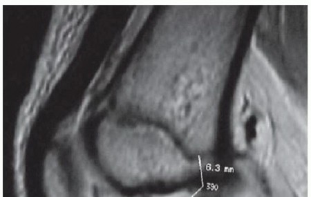 Optimizing ACL Reconstruction for Skeletally Immature Patients
