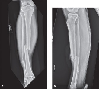 Illustration of compartment syndrome case - Dr. Mohammed Hutaif
