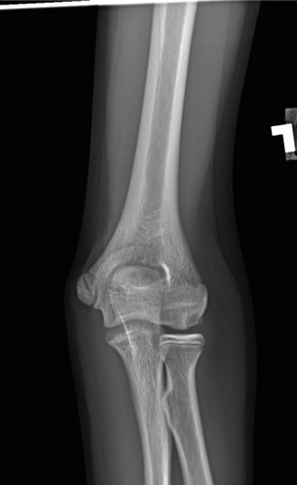 Elbow Osteochondritis Dissecans: Diagnosis & Treatment for Athletes
