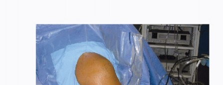 Understanding Shoulder Arthroscopy: The Basics You Need