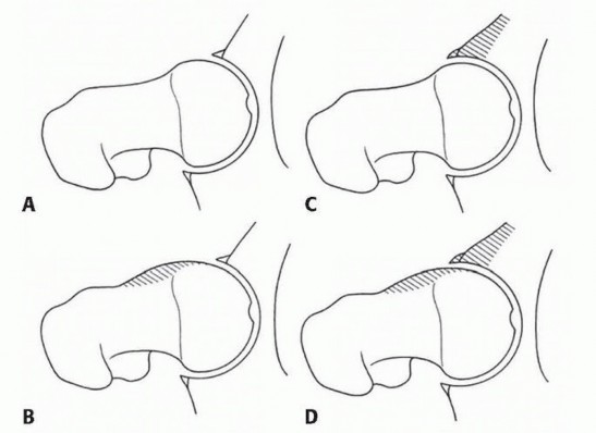 Anterior FAI Relief: Mini-Open Anterior Approach Explained