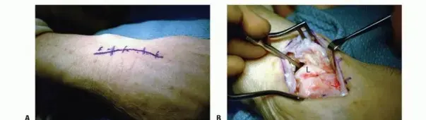 صورة توضيحية لـ تثبيت الرسغ الجزئي: حل دائم لآلام الرسغ المزمنة وتحسين حركته في اليمن والخليج