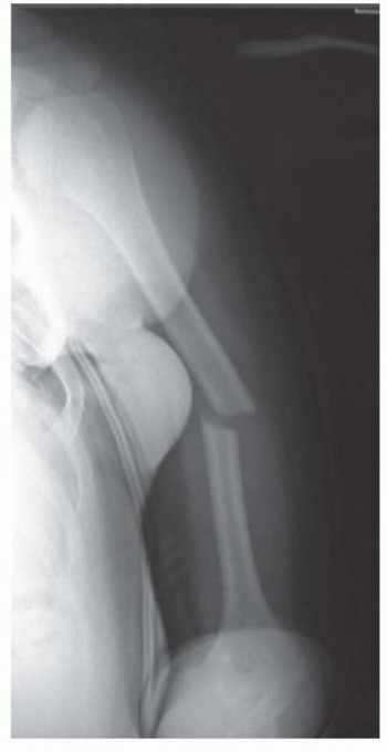 Plate Fixation for Humeral Shafts: Optimal Stability via Six Cortices