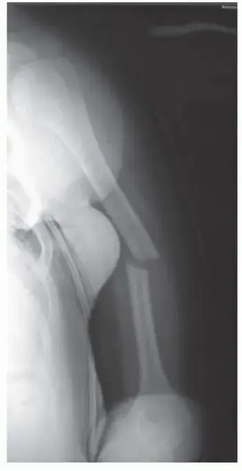 صورة توضيحية لـ دليلك الشامل لكسور عظم العضد: التشخيص، العلاج، والتعافي مع الأستاذ الدكتور محمد هطيف