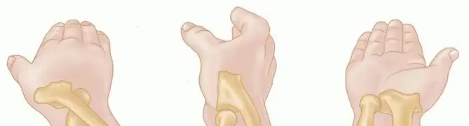 كسور رأس وعنق الكعبرة: دليلك الشامل لاستعادة حركة مرفقك ونشاطك
