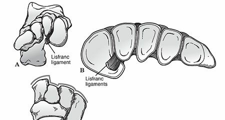 Illustration 15 for Mastering First MTP Joint & Forefoot Fractures: A Comprehensive Guide