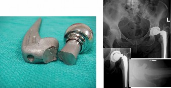 Reconstruction Materials: What You Need to Know About Associated Complications
