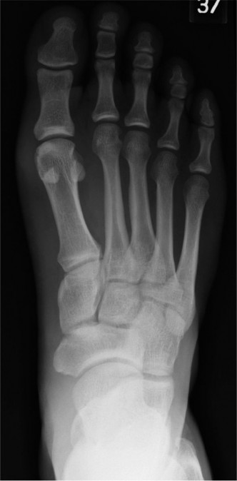 Diagnosing Plantar Plate Rupture: A Challenging Football Injury Case