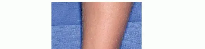 صورة توضيحية لـ تنظير مفصل الكاحل: الحل الجراحي المتقدم لآلام الكاحل وإصاباته الرياضية