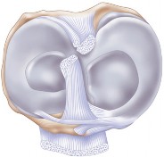 Illustration 7 for Optimize Tibial Component Alignment: Techniques for TKA Success