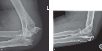 Tension Band Wire: Dynamic Compression for Olecranon Fractures