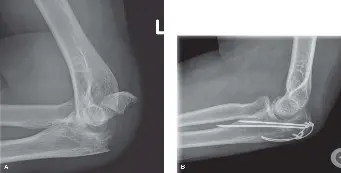 صورة توضيحية لـ كسر الزج بالمرفق أسبابه، أعراضه، تشخيصه، وعلاجه بتقنية ربط حزمة الشد مع الأستاذ الدكتور محمد هطيف