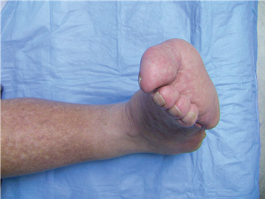 Illustration 120 for First Metatarsal Surgery: Expert Solutions for Foot & Ankle Pain