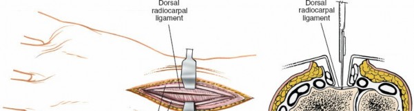 Illustration 22 for Dorsal Wrist Approach: Expert Access to the Column of the Distal Radius