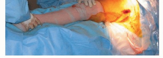 صورة طبية: نصف مفصل الورك: دليلك الشامل لدواعي الاستخدام والأنواع في صنعاء