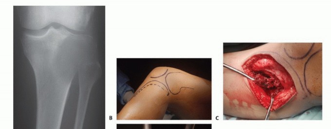 صورة طبية: تجنب الجراحة الكبرى: علاج أورام العظام بالنيتروجين السائل بتقنية الصب المباشر