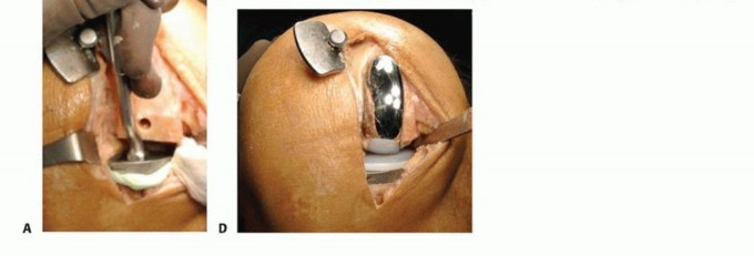 Illustration 20 for Unicondylar Knee Arthroplasty: Is This Your Solution to Knee Pain?